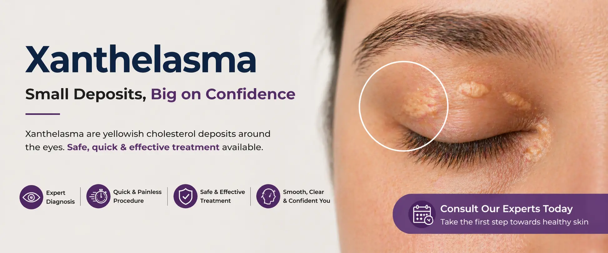 xanthelasma Sub banner