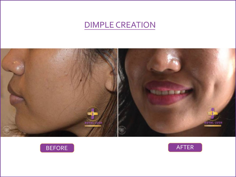 Dimple-Creation-1 (1) (1)