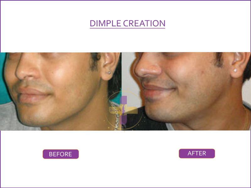 Dimple-Creation-1 (2)