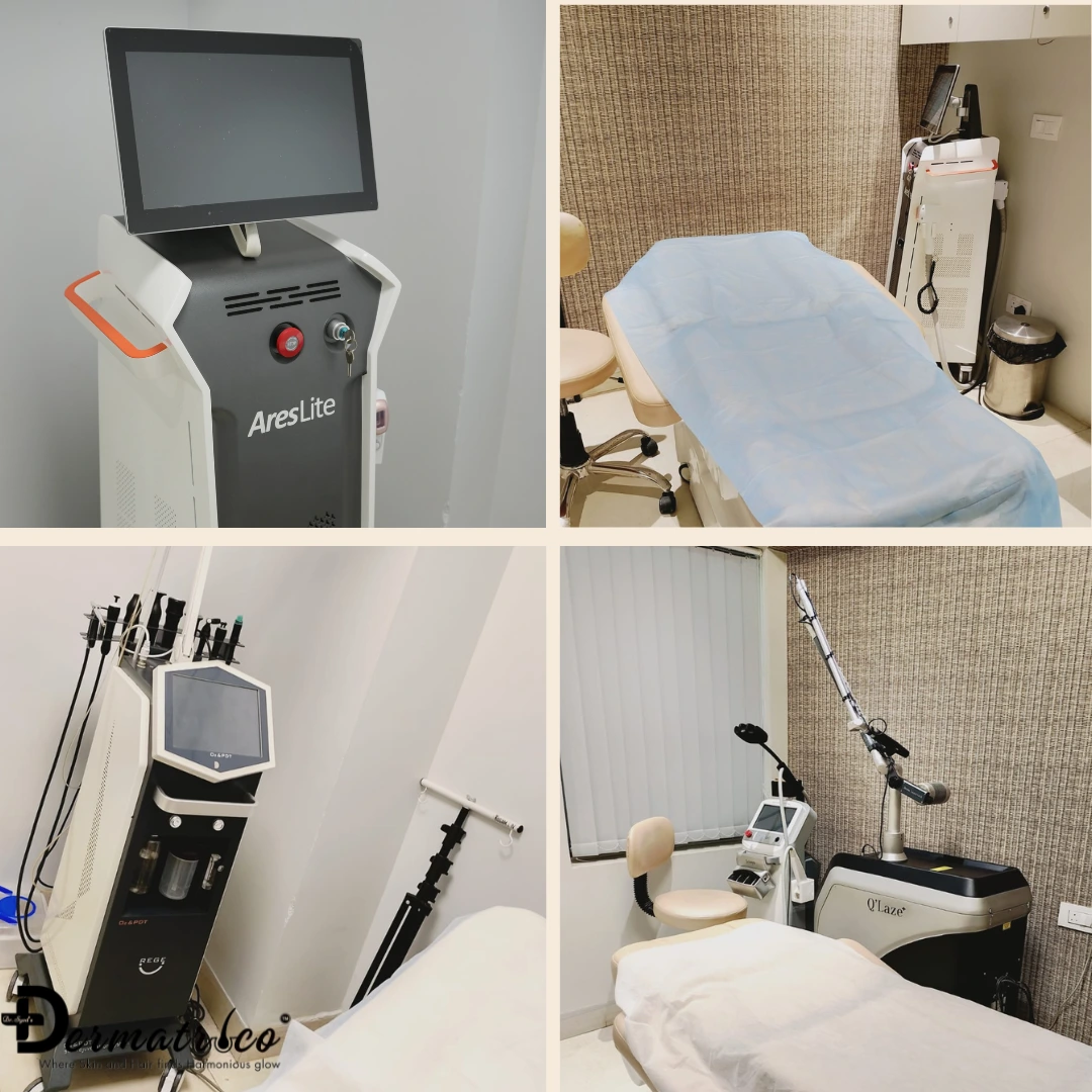 Thread Lift Treatment in Delhi