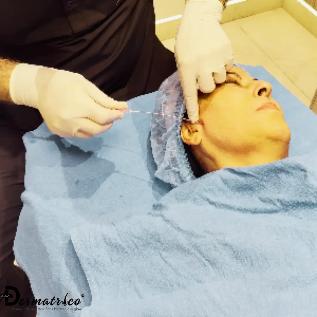 Thread Lift Treatment in Delhi