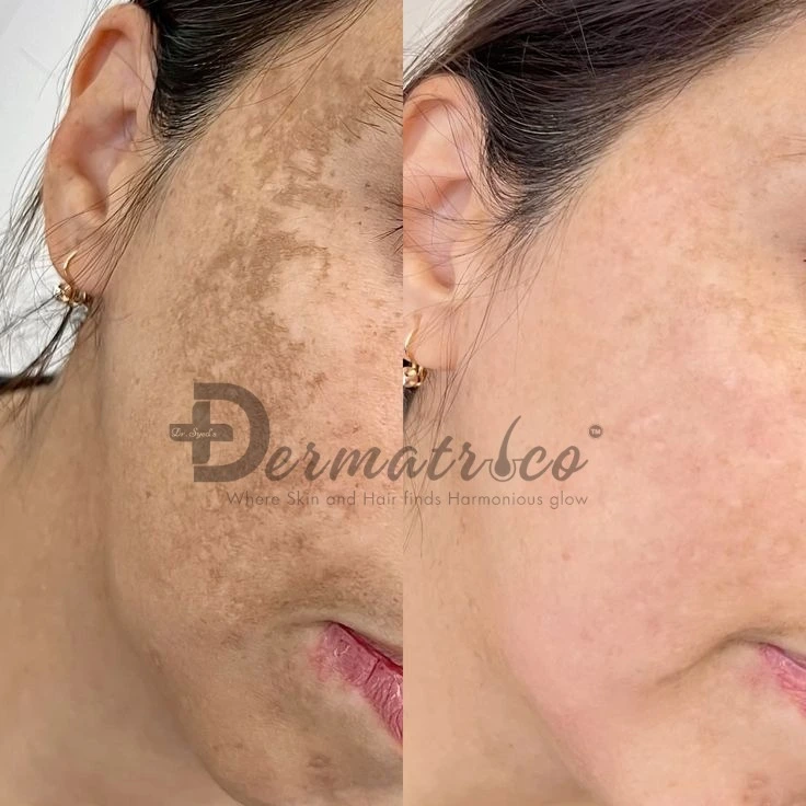 acne treatments