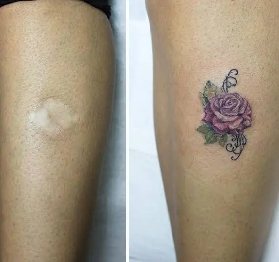 tattoo treatments