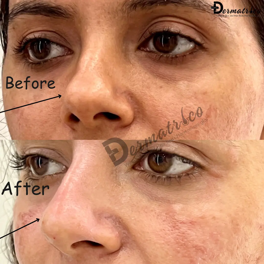 Lip Filler Treated by Dr Syed in Royal Lush Clinic IN South Delhi Before after