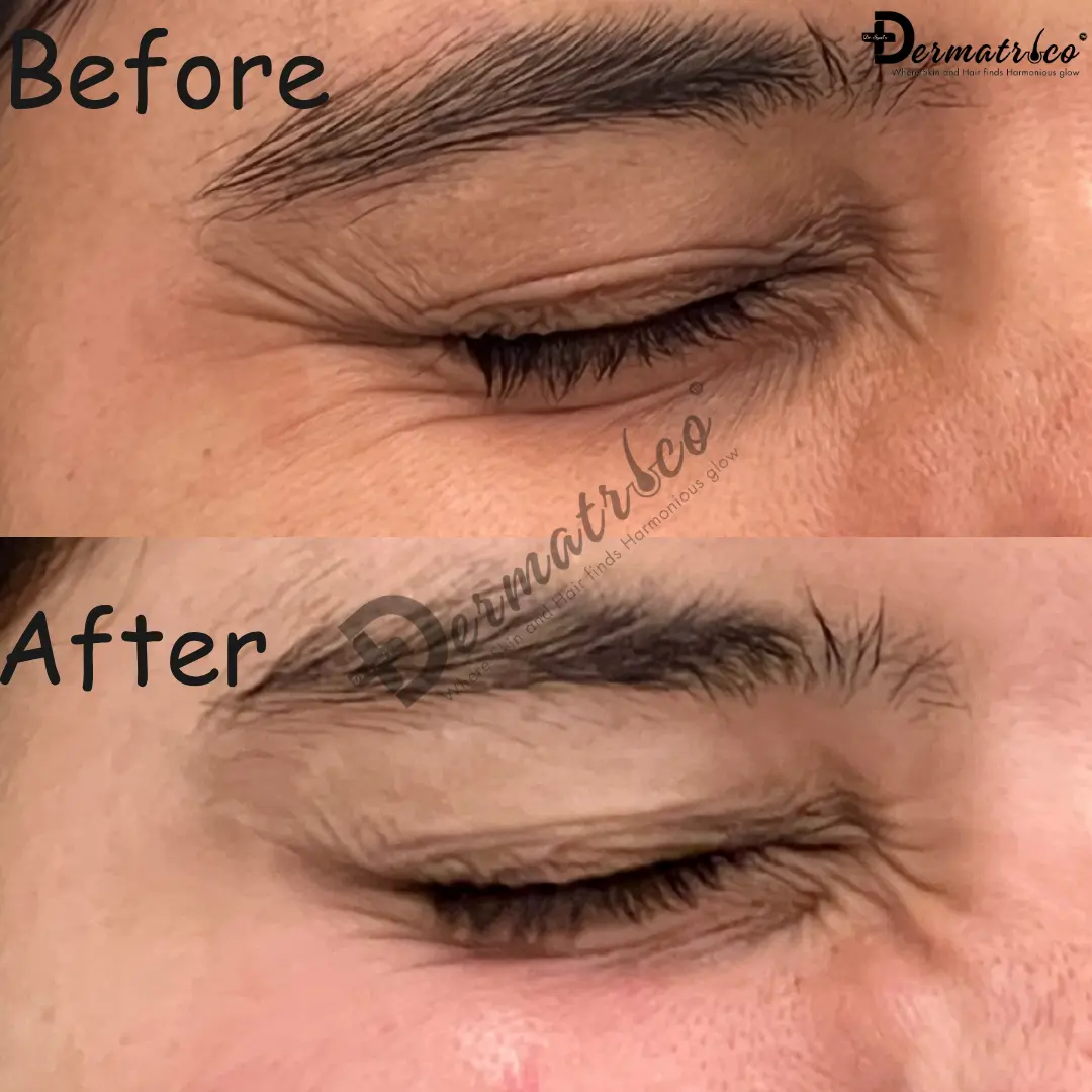 Eyebrows treatments