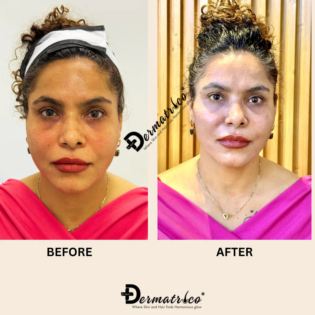Thread Lift Treatment in Delhi