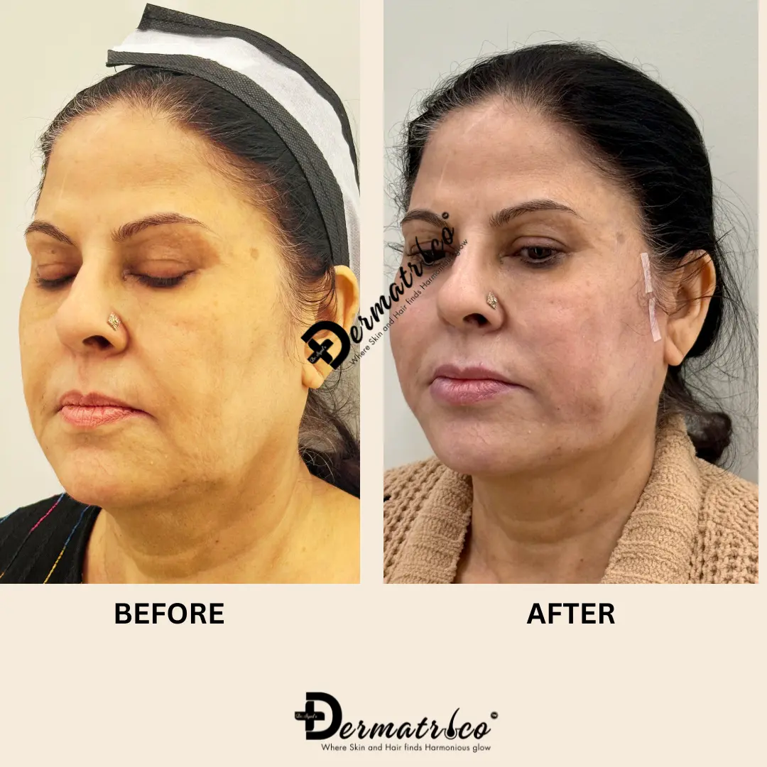Thread Lift Treatment in Delhi