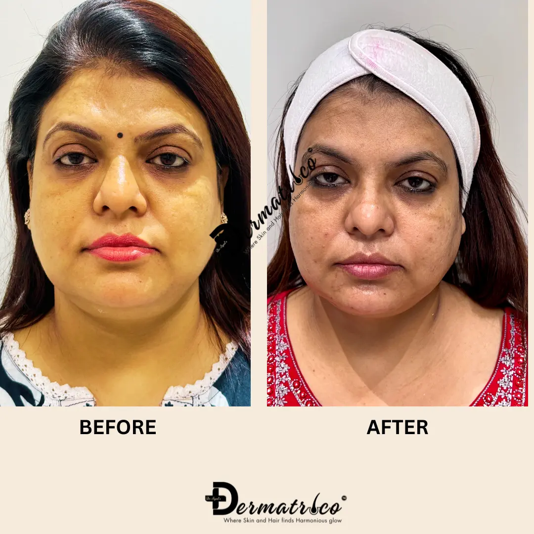 Thread Lift Treatment in Delhi