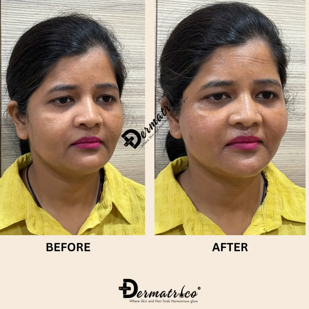 Thread Lift Treatment in Delhi