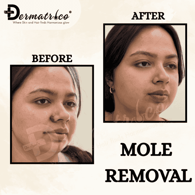 laser hair removal Skin Clinic Near Greater Kailash, Delhi– Trusted Skin Specialist & Dermatologist