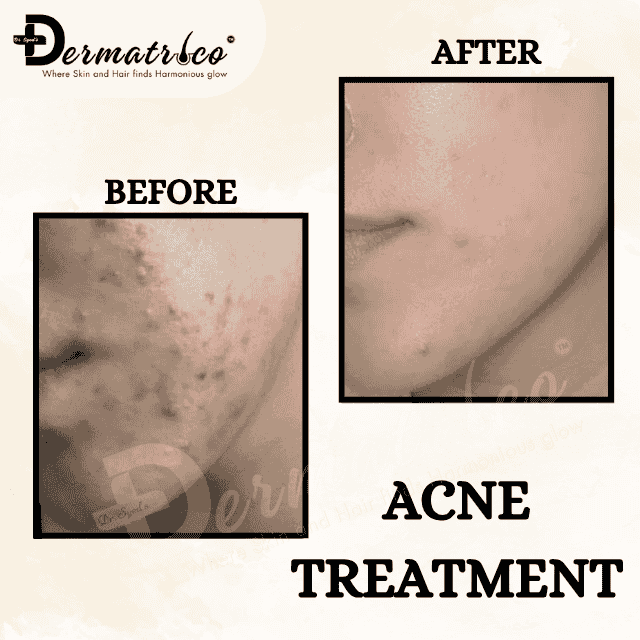 acnetreatment Best Skin Clinic near Panchsheel Park – Trusted Skin Specialist & Dermatologist