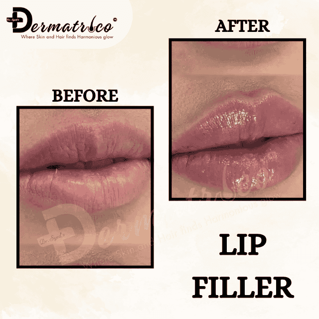 lif fillers Best Skin Clinic near Panchsheel Park – Trusted Skin Specialist & Dermatologist