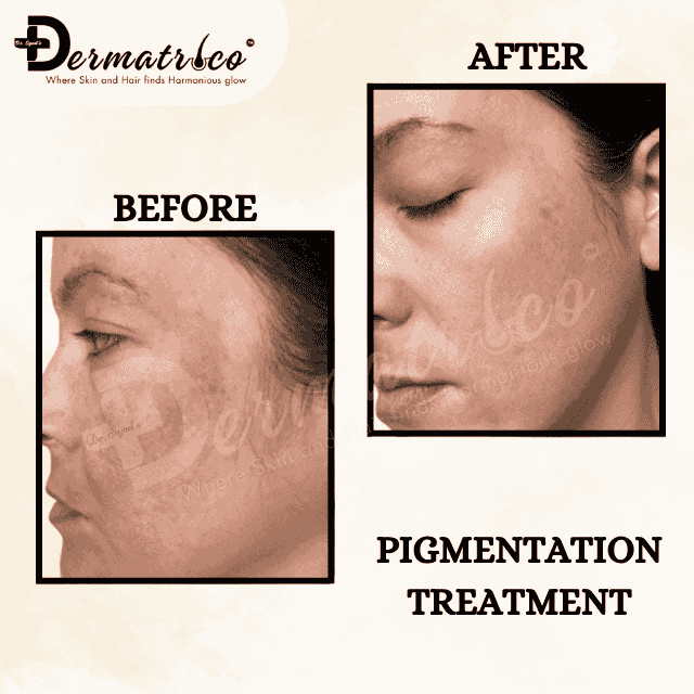 pigmantaion Best Skin Clinic near Panchsheel Park – Trusted Skin Specialist & Dermatologist